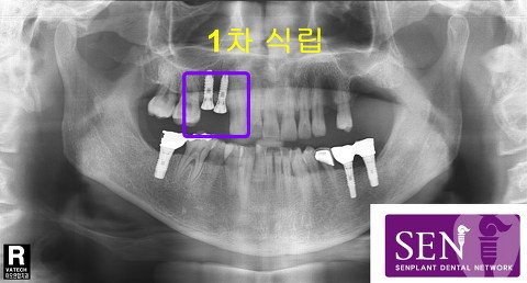 임플란트식립1