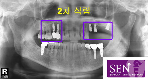 임플란트식립2