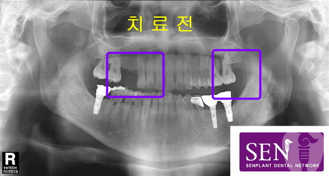 치료전