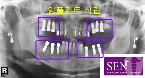 임플란트시깁