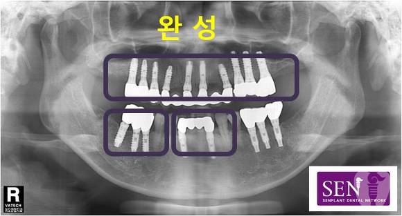 완성1