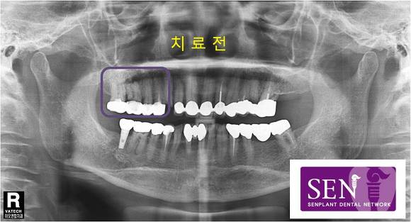 치료전