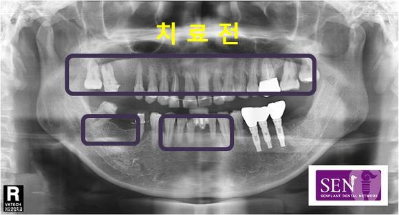 치료전1