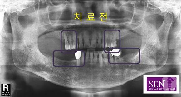 치료전1