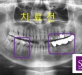 치료전11